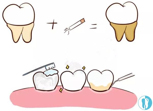 牙结石的形成过程