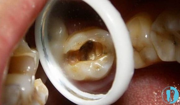 乳牙龋齿也会发展成根尖周炎