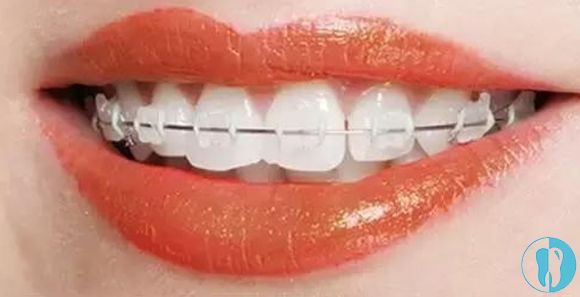 你知道牙齿整形多少钱吗